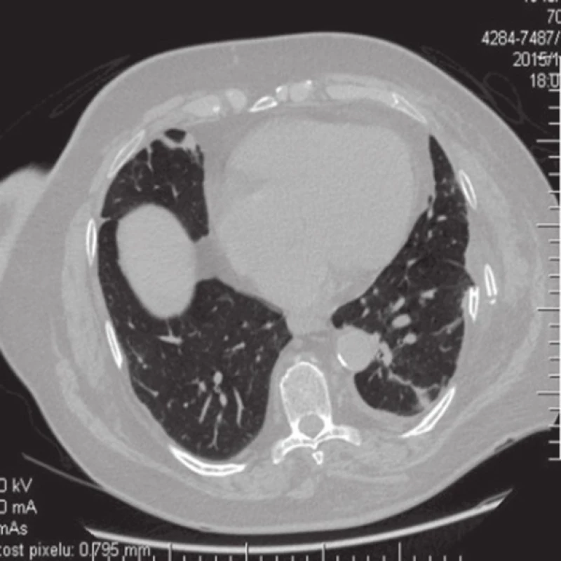 Sériová fr., prominence úlomků
Fig. 7: Ribs prominence
