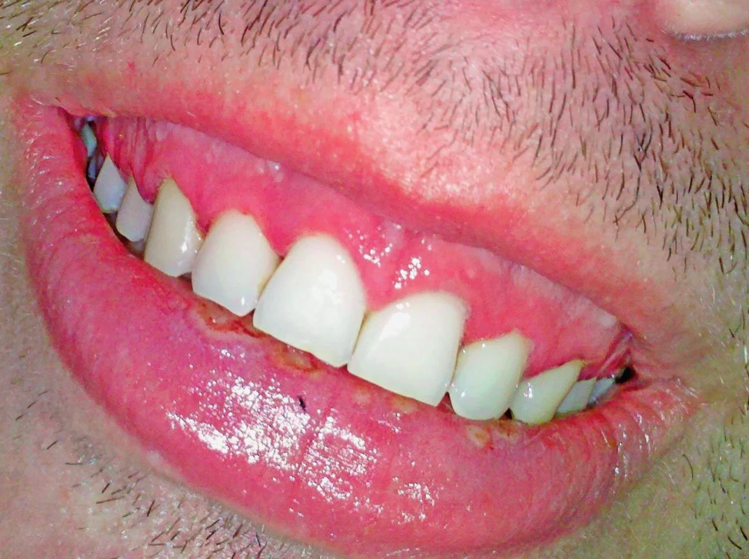 Gingivostomatitis herpetica v dospelosti.