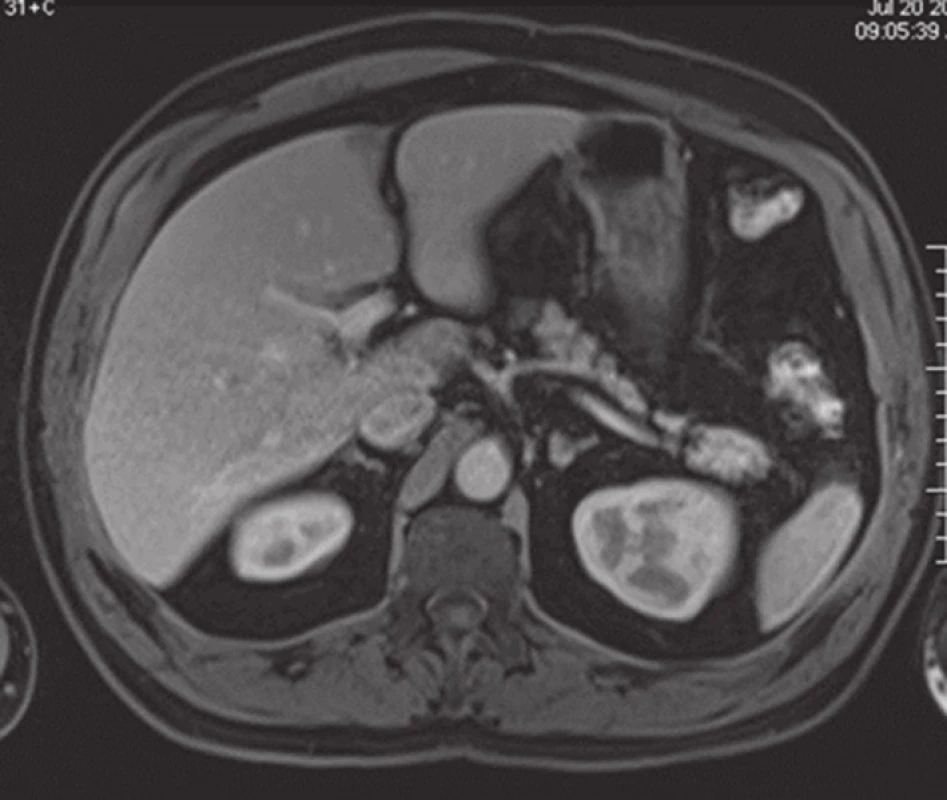 MR jater: Portální fáze s hepatospecifickou kontrastní látkou (Primovist, Bayer Schering, Germany)
V segmentu S4 je patrné hyposignální klínovité ložisko patřící pseudolézi.
Fig. 1: MRI of the liver: Portal-phase examination performed with hepatospecific contrast agent (Primovist, Bayer Schering, Germany). A hypo-signal wedge-shaped lesion representing the pseudolesion is visible in segment 4.