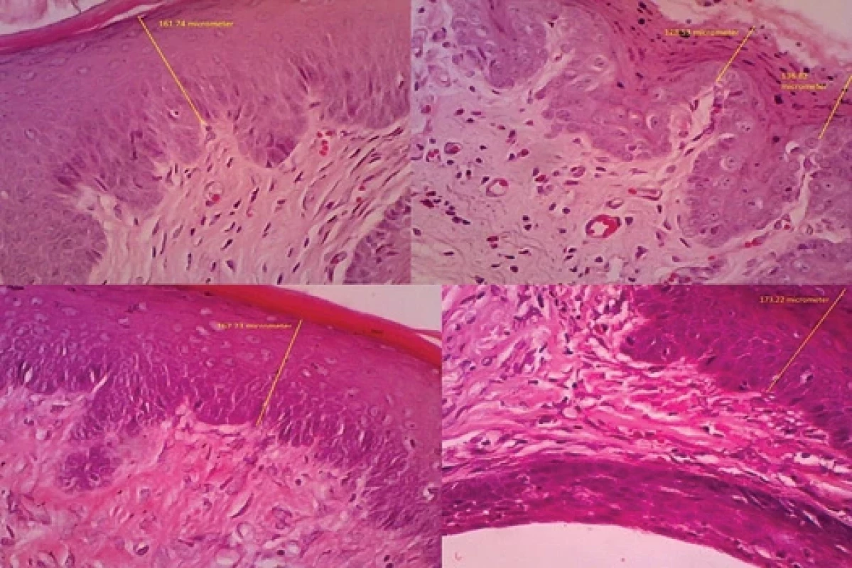 Histological evaluation of mandibular gingival mucosal wound healing in rabbits on day 14 post-treatment with a combination of ethanol extract of guava leaves and polyvinylpyrrolidone hydrogel.