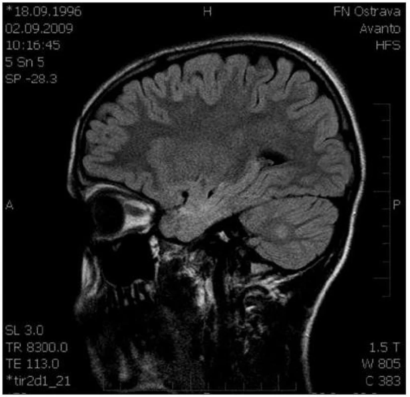 Sagitální řez CNS: MR FLAIR, ložisko zvýšené intenzity signálu pravé mozečkové hemisféry.
Fig. 3. Sagittal section of CNS: MR FLAIR, a focus of increased signal intensity of the right cellular hemisphere.