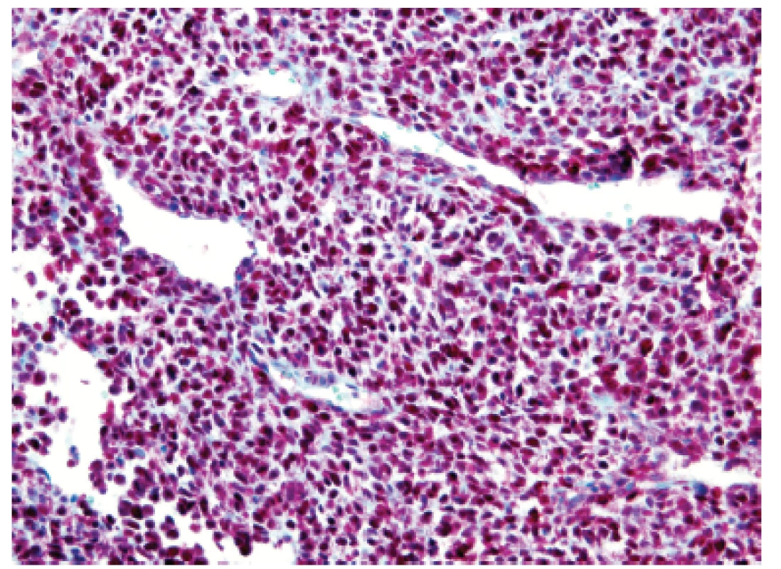 Kazuistika <b>2</b>. Difúzní intenzívní jaderná pozitivita antigenu CCNB3 v nádorových elementech (IHC, 200x).