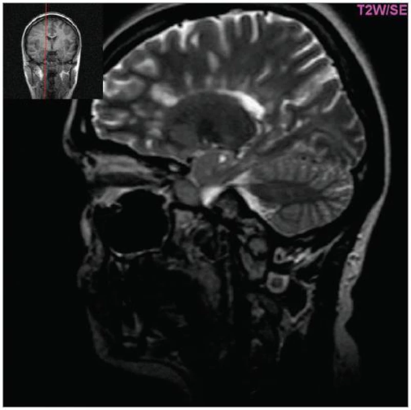 Hyperintenzní ložiska v okolí corpus callosum (tzv. Dawsonovy prsty, T2W, sagitální řez, pac. 31 let, ž, RS od 2000).