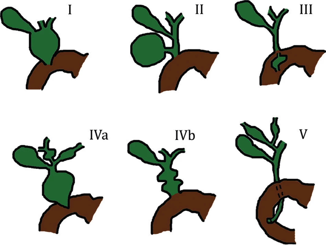 Todaniho klasifikace cyst choledochu (schéma autora)
Fig. 6: Todani‘s classification of choledochal cysts (author‘sscheme)