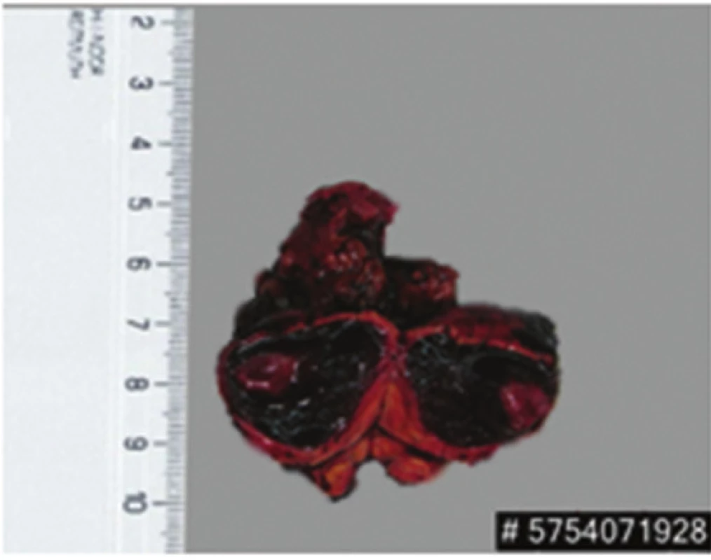 Exstirpát extraadrenáního paragangliomu
Fig. 5: Extirpated paraganglioma