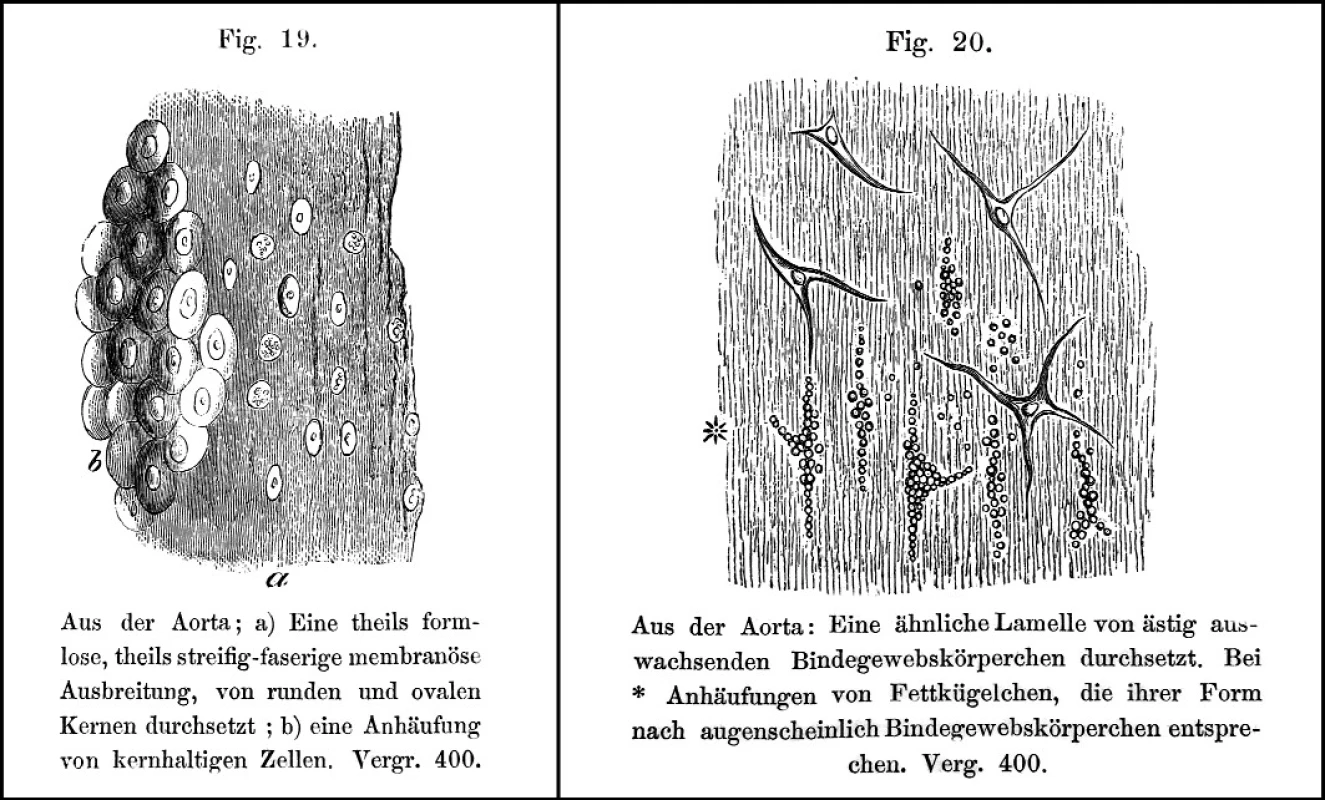 Histologické obrazy (dřevoryty) intimálních lézí aorty. 
Vlevo nakupení jader v pseudomembráně, vpravo vazivové buňky obsahující tukové kapénky [?pěnité buňky]
