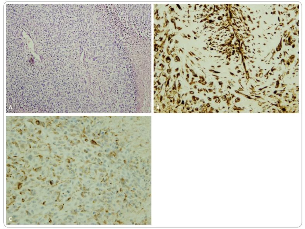 Histologie maligní formy cystosarkoma phyllodes.
A. Sarkomatoidní architektura, jaderné monstrozity, v pravém zevním a levém dolním okraji nekróza. Barvení HE, zvětšeno 100krát.
B. Imunohistochemická reakce prokazující vimentin: mezenchymová složka nádoru, zvětšeno 100krát.
C. Imunohistochemické reakce prokazující cytokeratin: epitelová složka nádoru, zvětšeno 100krát.