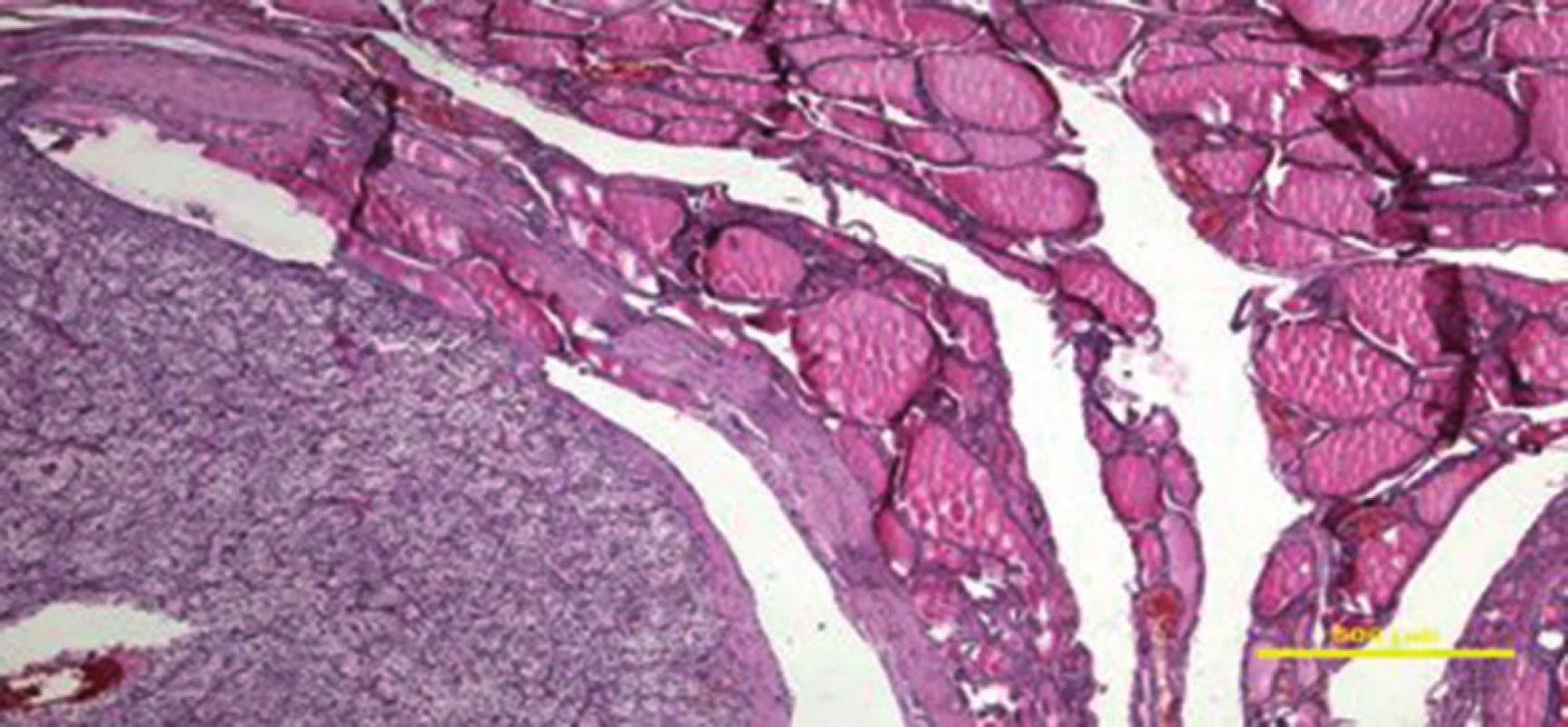 Histologický obraz – metastáza vlevo dole
Fig. 3: Histological image – metastasis below on the left