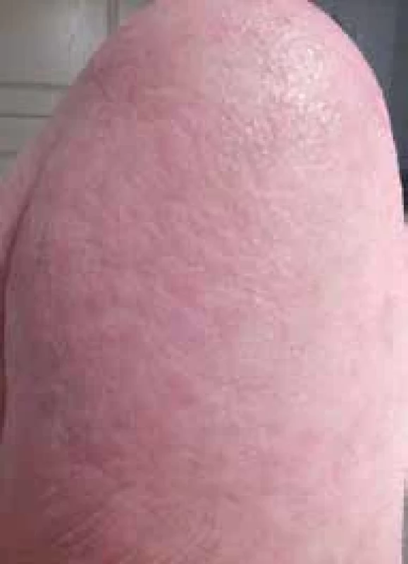 Exsudace, edém, exkoriace