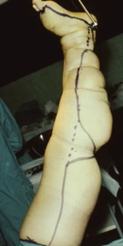 Ischemisation of lower limb and fascia-deep removal of aff ected tissue.