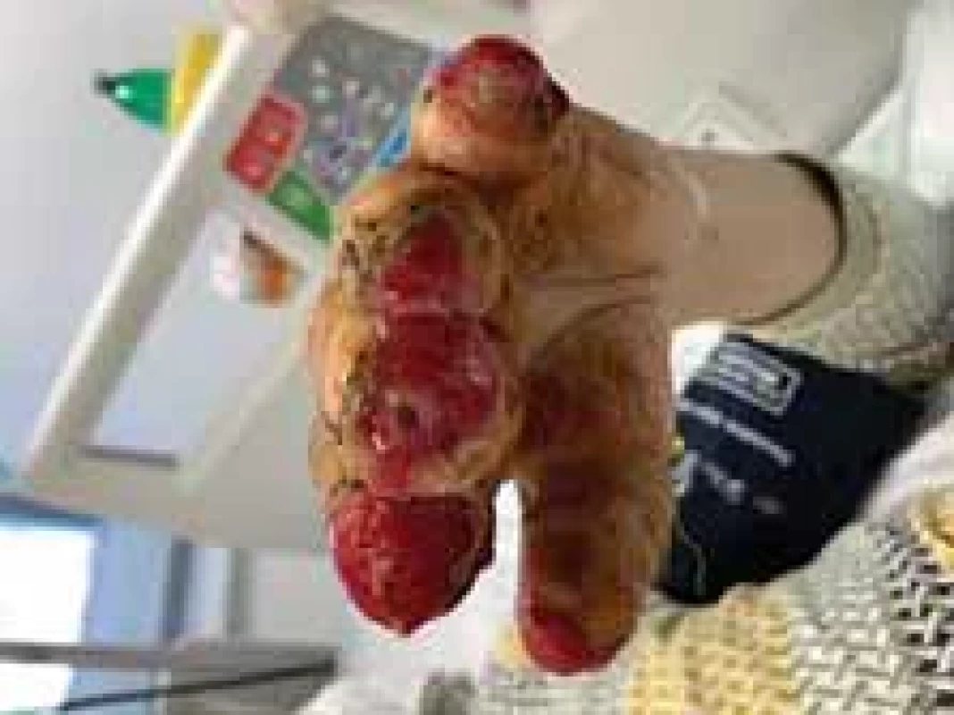 Appearance of left hand after operation (frontal view).