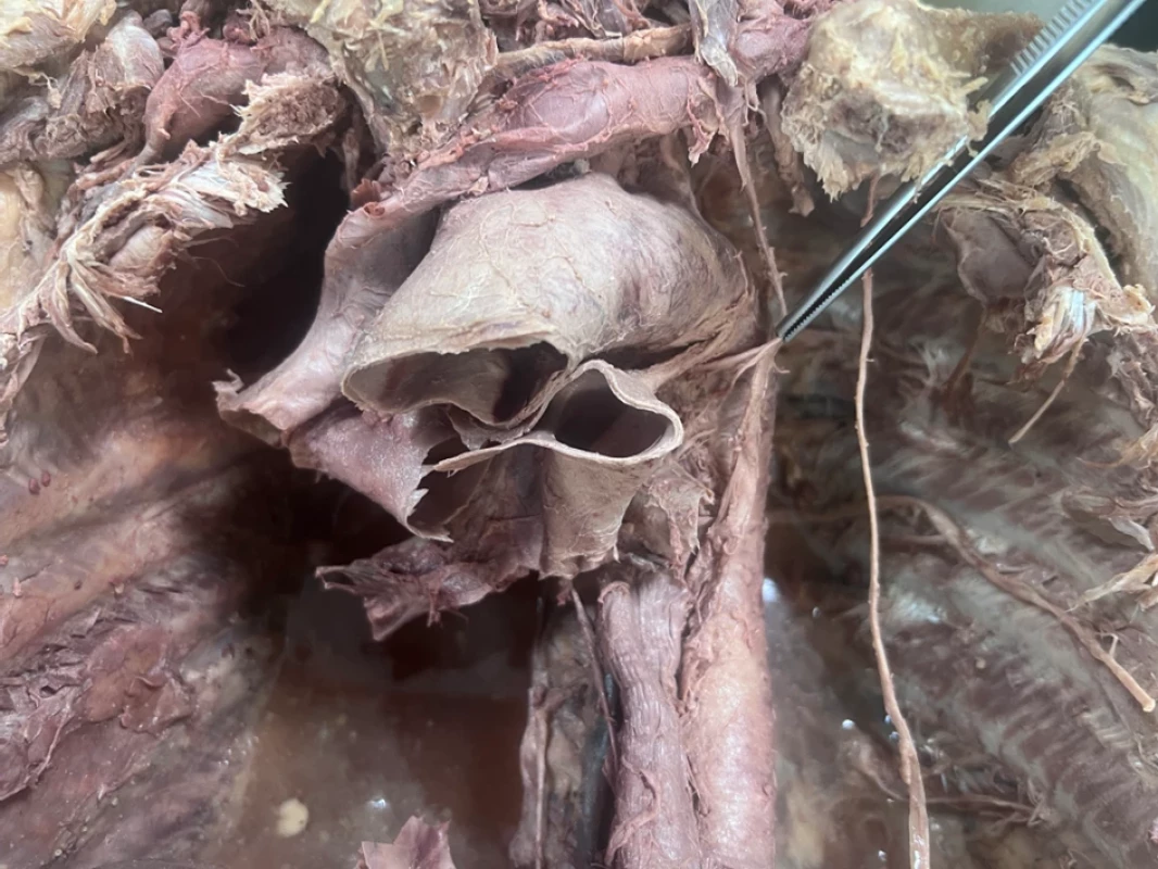 Topografie vztahu oblouku aorty a levého zvratného nervu; levý nervus laryngeus recurrens v pinzetě 