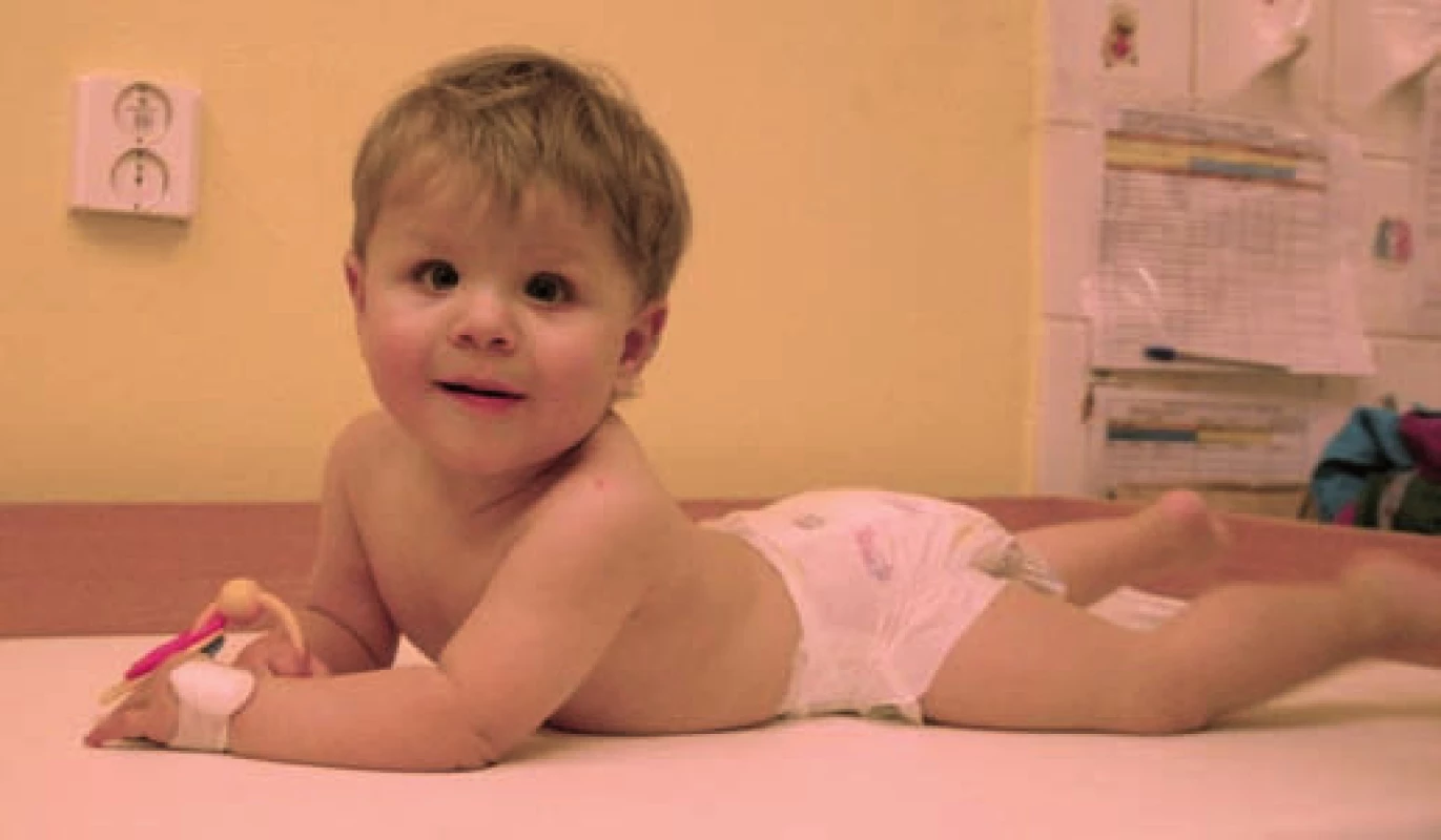 Pacient ve věku 2 let.
Fig. 4. Patient at the age of 2 years.