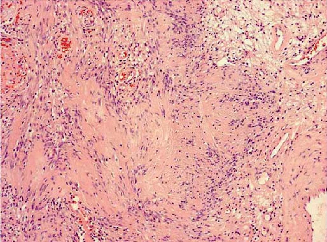 Typická struktura neurinomu (HE, zvětšení 100×).
Fig. 2. Typical neurinomal structure (HE, magnification 100×).