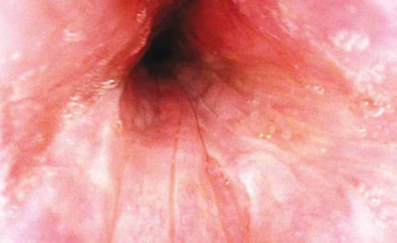 Úplná koncentrická obstrukce měkkého patra během DISE.
Fig. 2. Complete concentric palatal collapse during drug-induced sleep endoscopy.