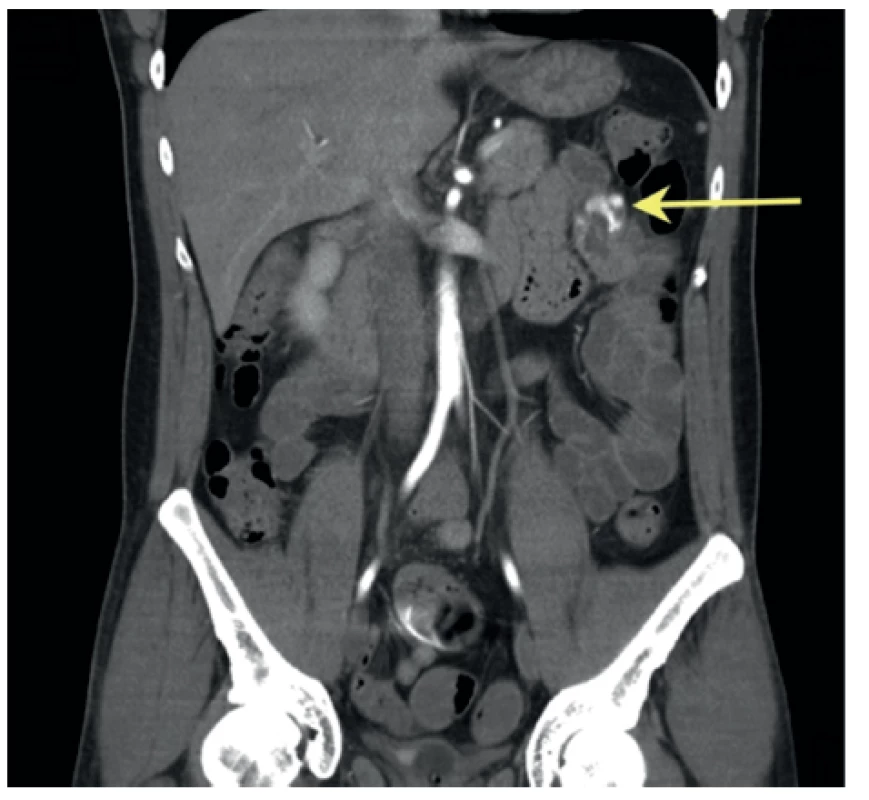  Koronární řez CT-AG
Šipka označuje intraluminální zdroj krvácení v orálním jejunu.
Fig. 1: Frontal section of CT-AG
The arrow marks the cause of bleeding intraluminally in oral jejunum