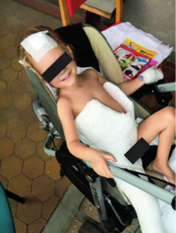 Imobilizace končetiny v sádrové spice po operaci kyčle pro aviární osteomyelitidu.
Fig. 5. Post-operative immobilization of lower extremity.