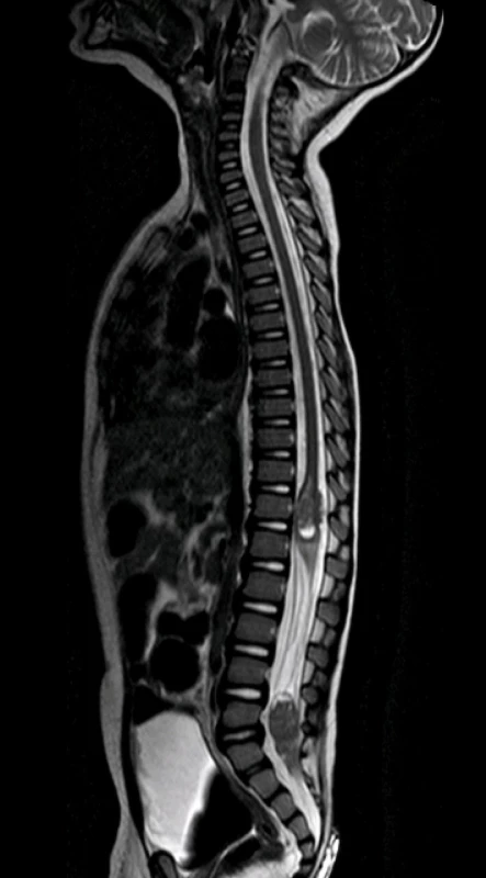 Magnetická rezonance: T2 vážený obraz páteřního kanálu odhalující 2 metastatická ložiska Th11-L1 a L4-S2
Image 5: Magnetic resonance: T2-weighted image of spinal cord showing 2 metastatic foci Th11-L1 and L4-S2