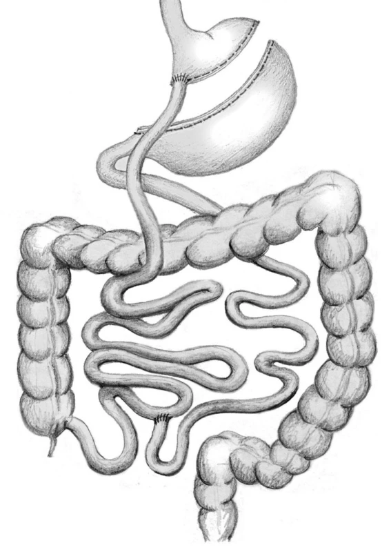 Roux-Y gastrický bypass
Fig. 4: Roux-en-Y gastric bypass