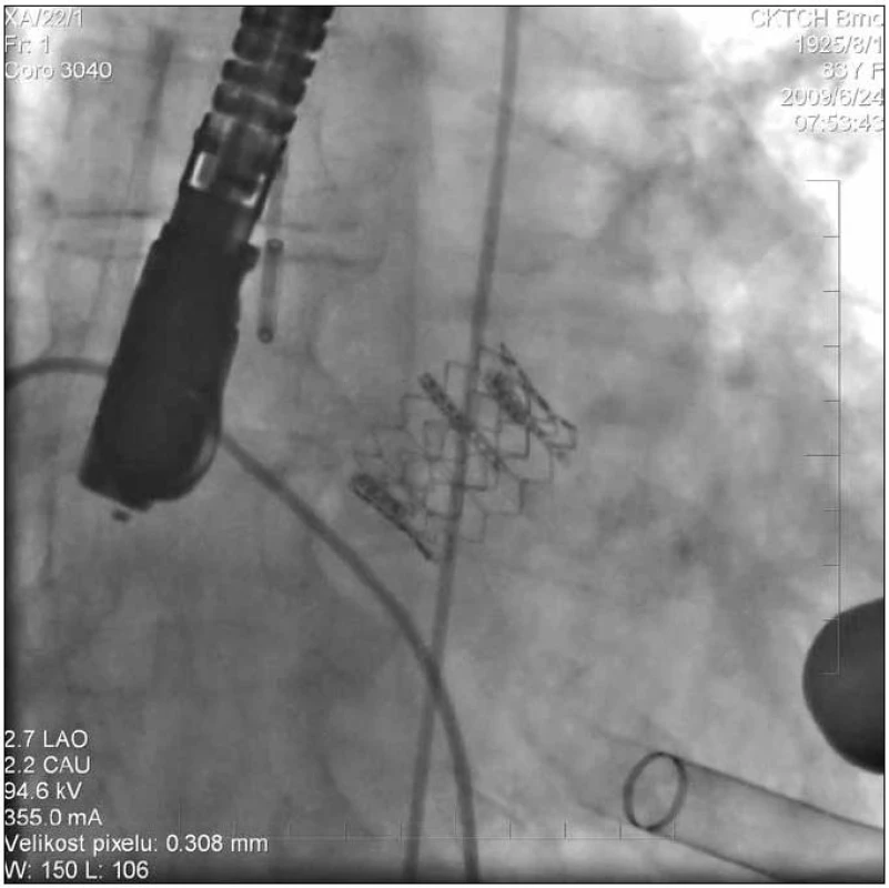 Implantace bioprotézy do stenotického aortálního ústí transapikální cestou.
