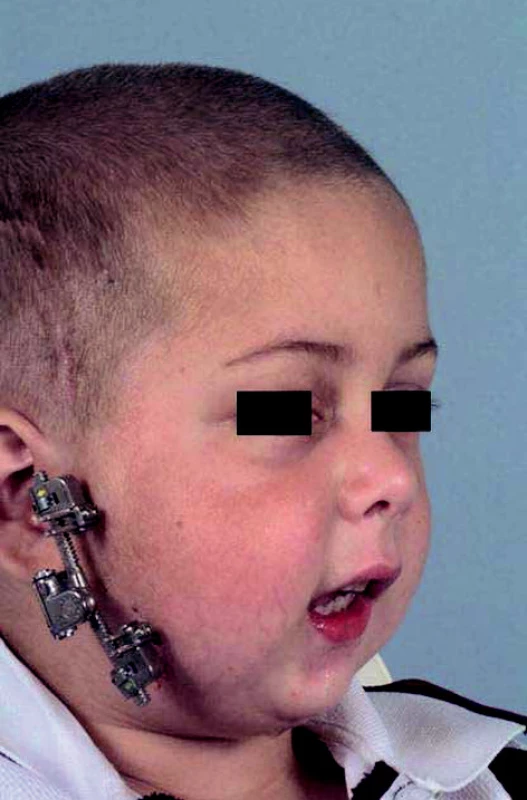 An example of a standard extraoral distractor for lengthening the mandible