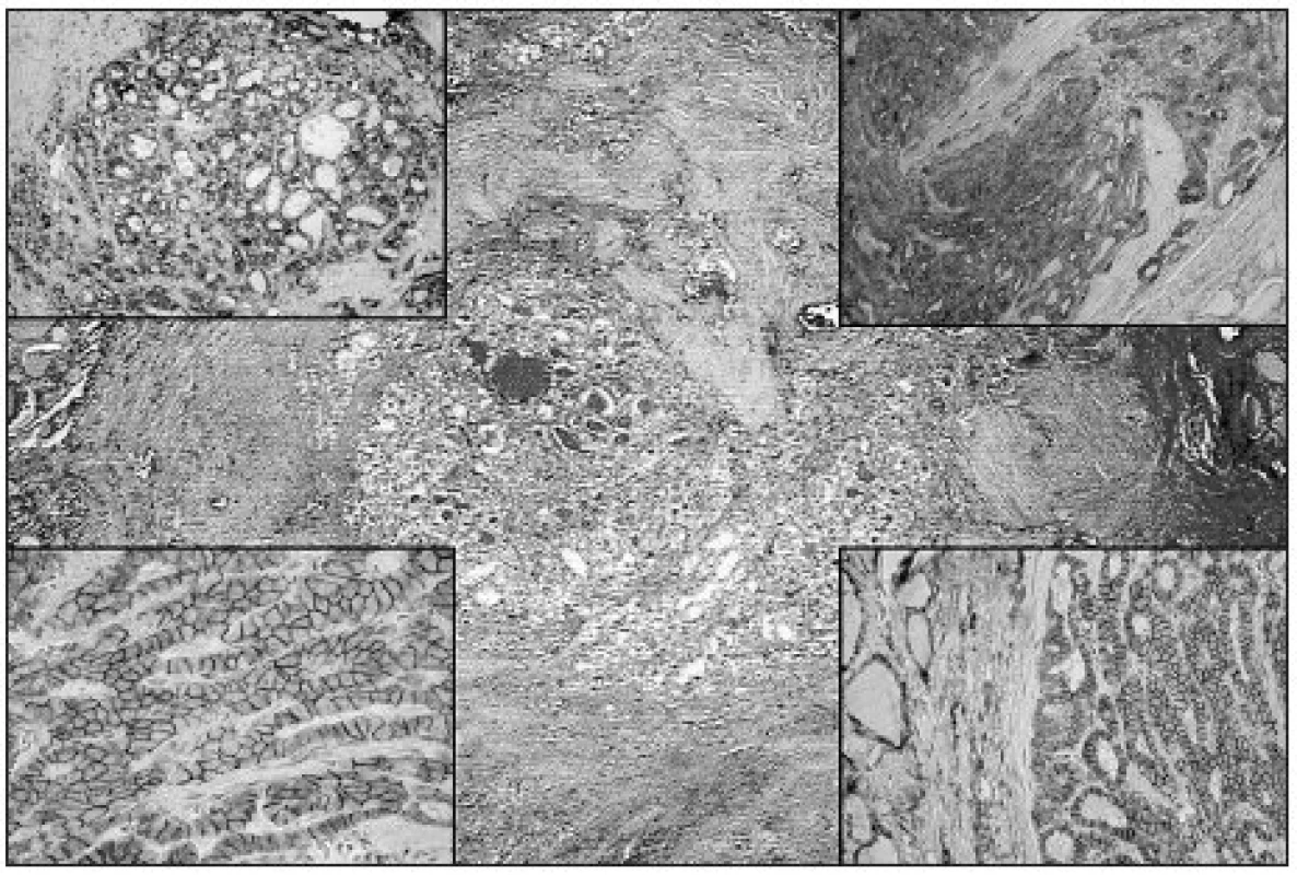 mPTC with follicular growth pattern resembling fibrosing thyroiditis (HE, original magnification 40x). Upper left: Diffuse strong Gal3 expression in mPTC (original magnification 100x). Upper right: Diffuse strong expression of CK19 in mPTC (original magnification 100x). Lower left: Diffuse strong membranous NCAM expression in mPTC (original magnification 200x). Lower right: Diffuse strong expression of Ecad in mPTC (original magnification 100x)