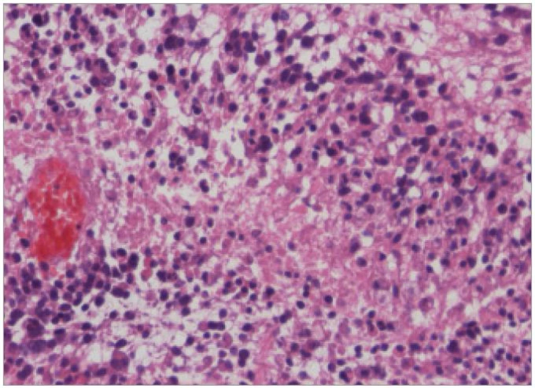 Hematoxylin-Eosin, geografická nekróza s palisádováním astrocytů v rámci GBM, zvětšení 200krát.
