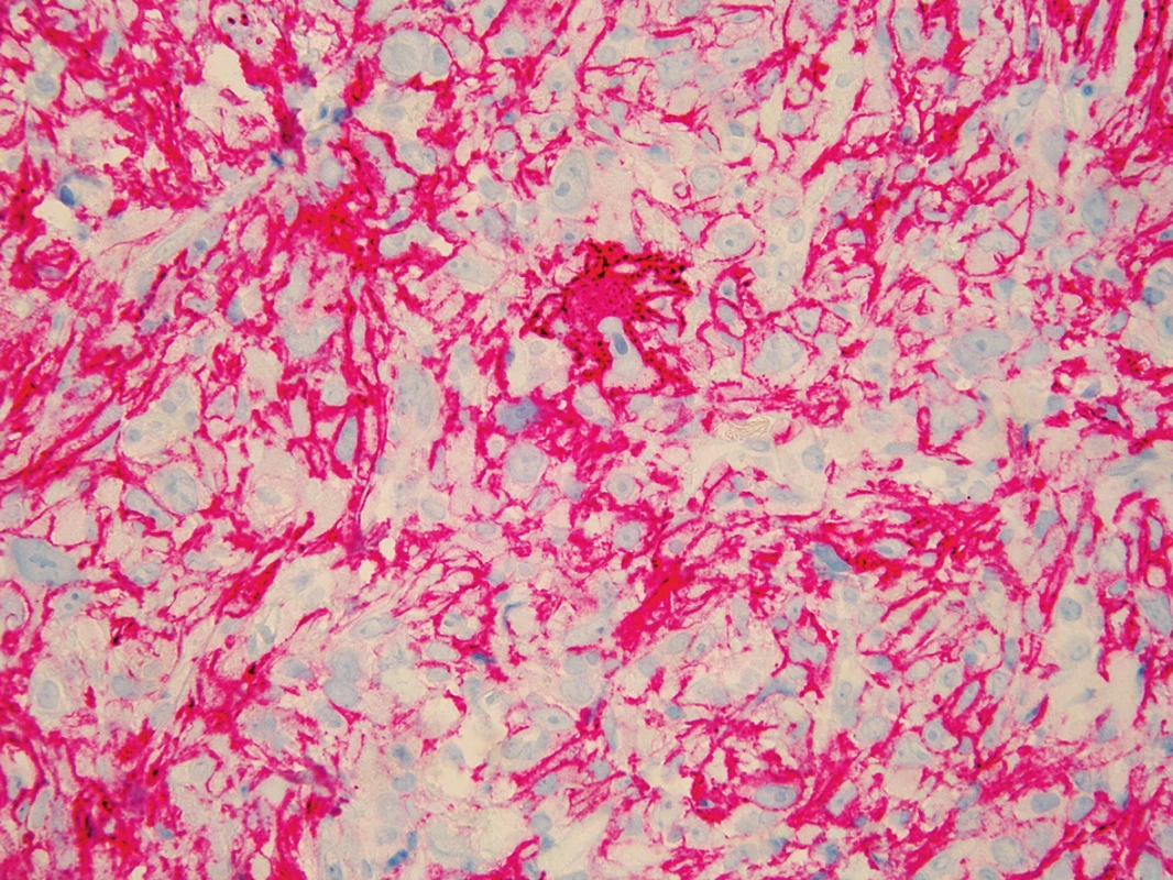 Imunohistochemické vyšetření – pozitivita CD10