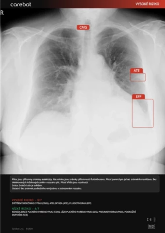 Příklad skutečně pozitivní predikce AI:Původní popis verifikovaný seniorním radiologem potvrzuje přítomnost chronických fibrotických změn, zvětšení srdečního stínu a pleurálního výpotku. AI správně identifikovala všechny 3 patologické stavy jako „vysoké riziko“. Z hodnocení radiologů v multi-reader studii označil nálezy správně pouze RAD 3, zatímco RAD 1 a RAD 2 částečně nebo nesprávně hodnotili přítomnost uvedených abnormalit. 