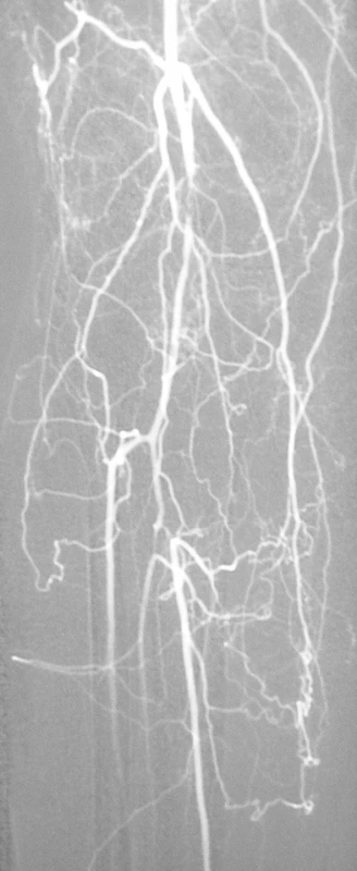 Digitálna subtrakčná angiografia – kritická stenóza arteria poplitea a tractus tibiofibularis na pravej dolnej končatine
Fig. 2. Digital subtraction angiography – a critical stenosis of the popliteal artery and of the tibiofibular tract on the right lower extremity