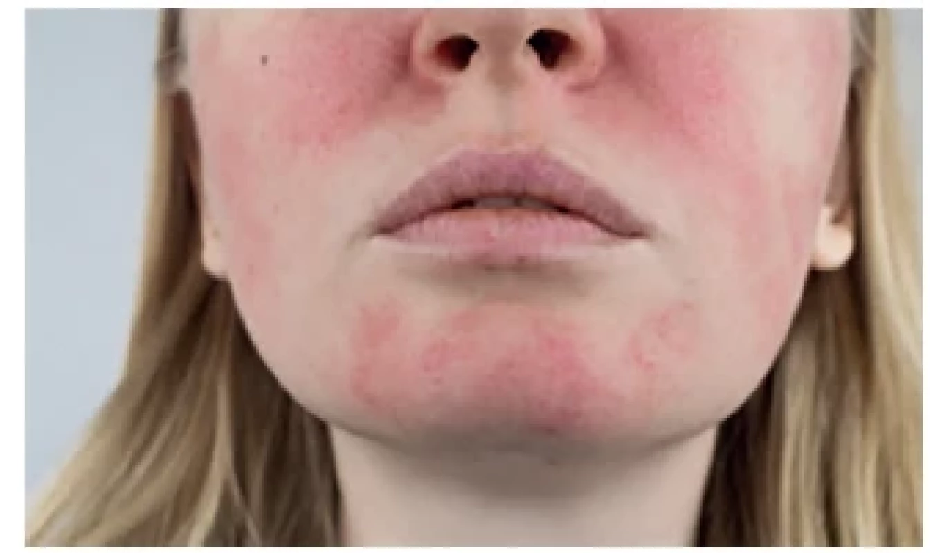 Erytematoteleangiektatický typ