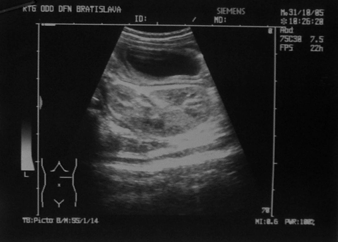 Sonografický nález, cysta s hrubou stenou pred obličkou.
Fig. 1. Sonographic finding, a cyst with a thick wall in front of kidney.