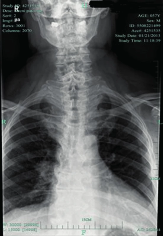 RTG HHA: rozšíření stínu horního mediastina oboustranně
Fig. 1: Thoracic outlet x-ray: bilateral widening of the upper mediastinum