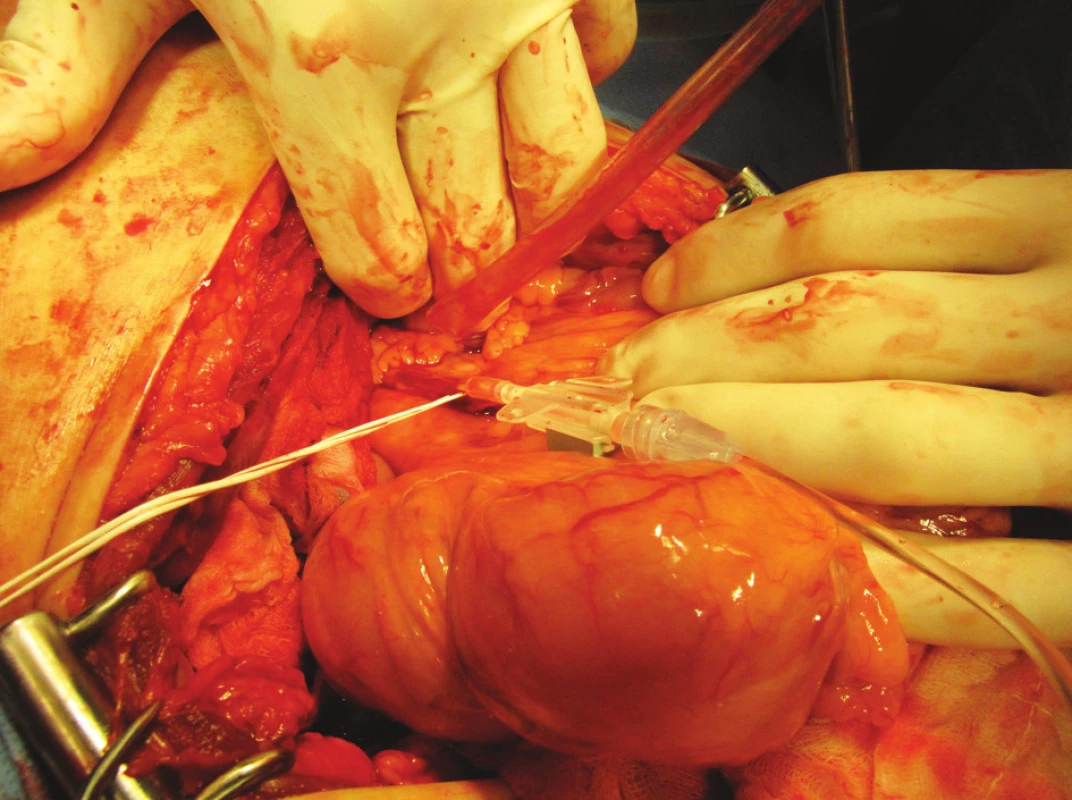Vena mesenterica inferior v závěsu levého tračníku se zavedenou kanylou k infuzi suspenze Langerhansových ostrůvků
Fig. 2. Vena mesenterica inferior in the left mesocolon, with a cannula, introduced for infusion of the islets of Langerhans suspension