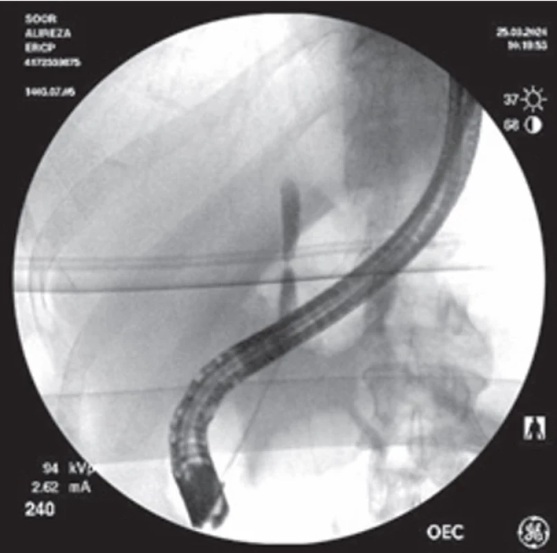 Severe post-OLT anastomotic stricture in a 52-year-old male patient (patient 6). A 3-mm coronary balloon was used to dilate the stricture, enabling subsequent TTS balloon dilation and successful stenting.  Obr. 6. Závažná post-OLT anastomotická striktura u 52letého pacienta (pacient 6). K dilataci striktury byl použit 3mm koronární balónek, což umožnilo následnou dilataci TTS balónkem a úspěšné za vedení stentu.