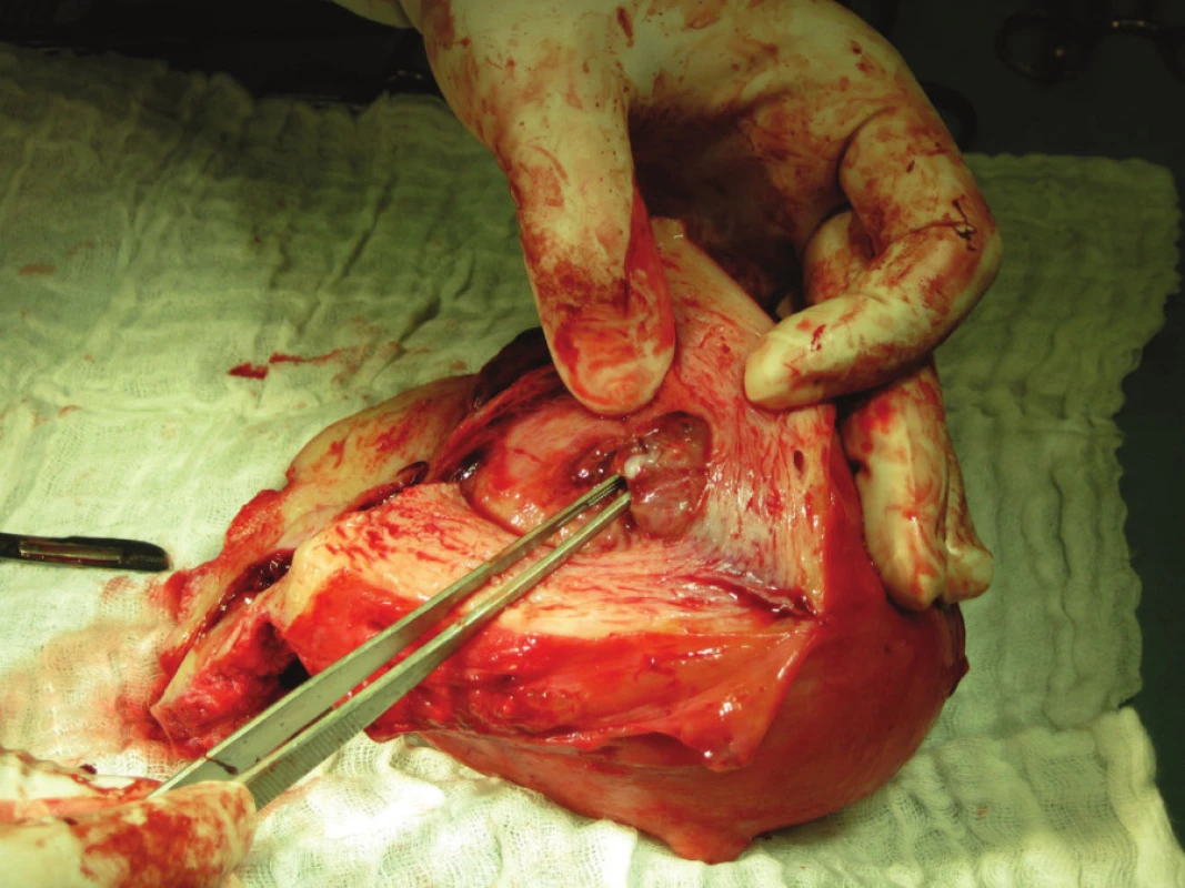 Low grade mucinózní adenokarcinom (varianta omezená na endometrium)