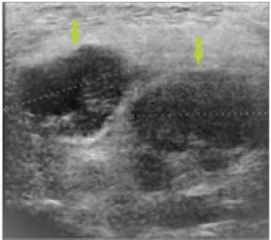 Sonografi e parotické žlázy s vícečetnými uzlinovými metastázami. Fig. 1. Ultrasound of the parotid gland showing multiple nodal metastases.