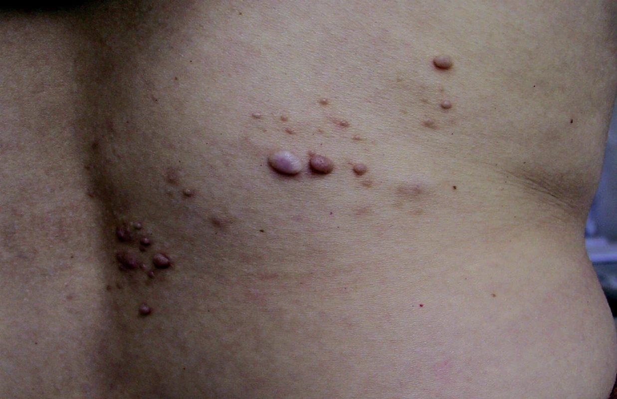 Segmentální neurofibromatóza, bederní krajina.