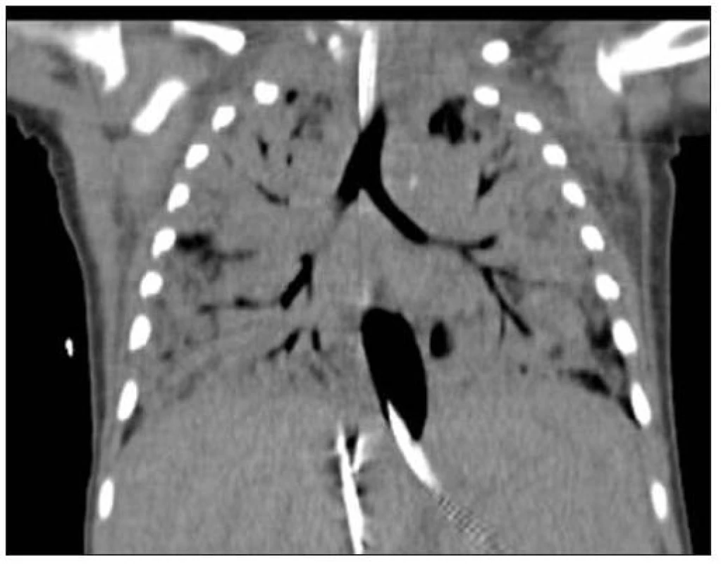 CT vyšetření 16.den (před konverzí V-V na V-A ECMO) u pacientky č. 3.
Fig. 2. CT imaging on day 16 (before V-V conversion to V-A ECMO) in female patient No. 3.