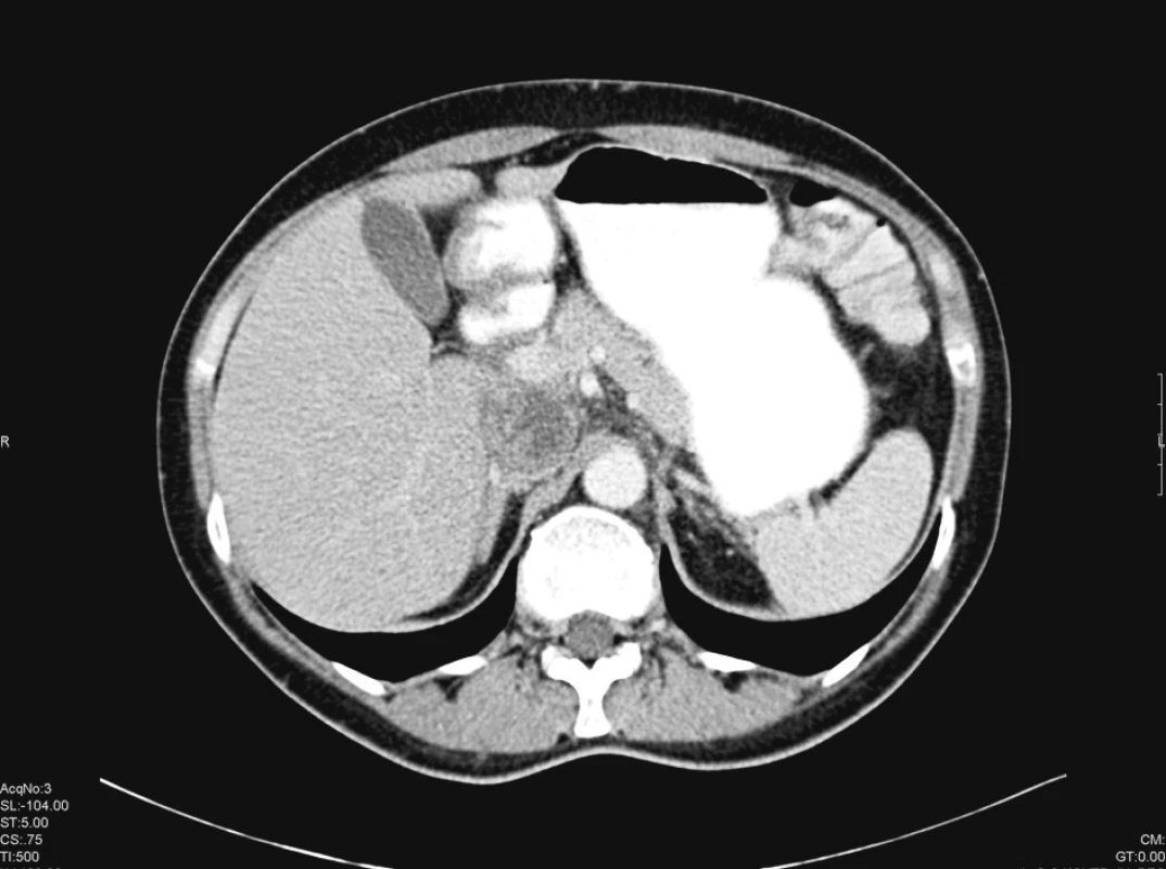 Masa tumoru v průsvitu v. cava v CT obraze
Pic. 1. Mass of tumor invading into v. cava inf. in CT picture