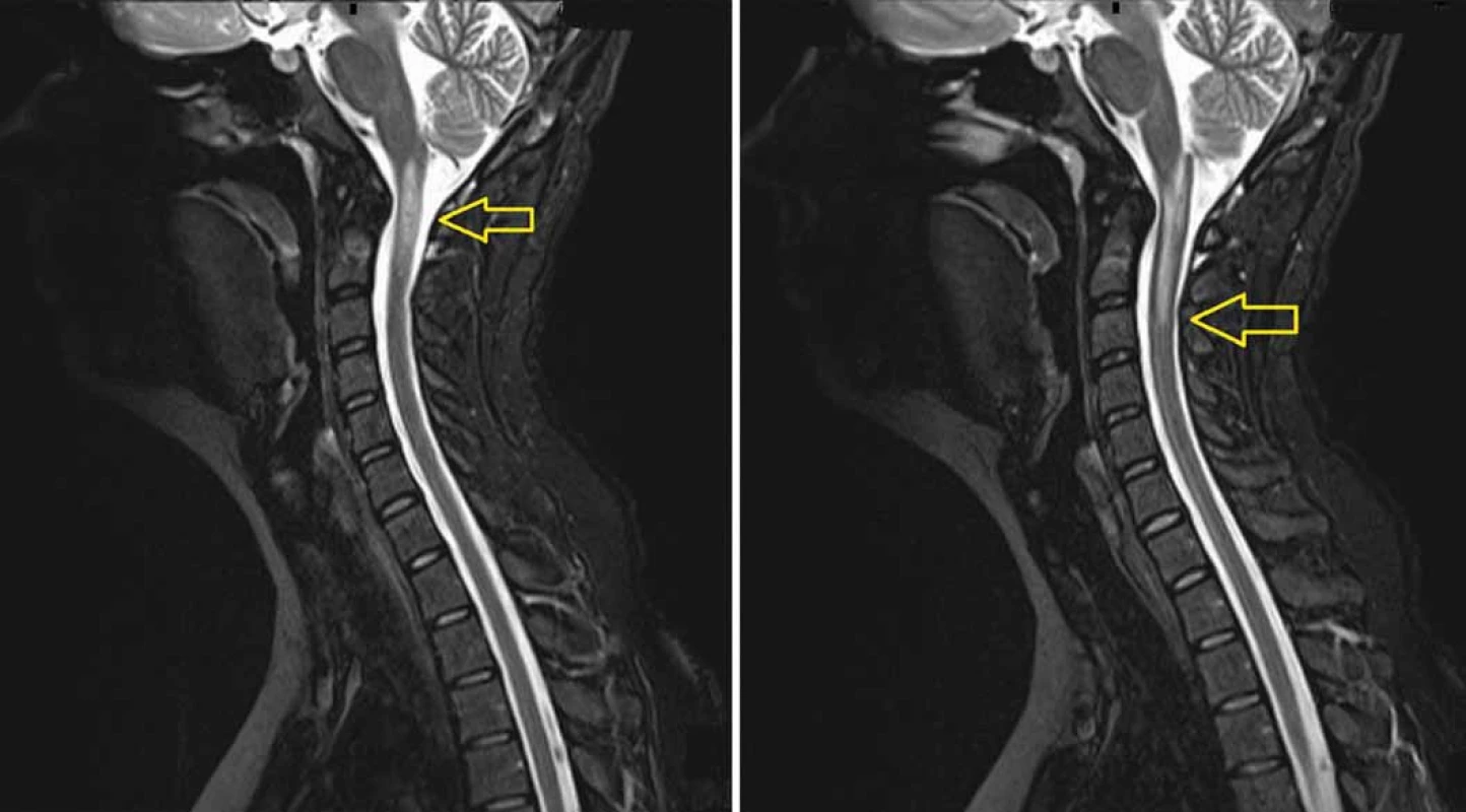 MRI (T2 vážený obraz) provedená 8 měsíců po protonovém ozáření.
Snímky ukazují radionekrózu v prodloužené a horní krční míše (A) zasahující až do úrovně C3 (B). Radionekróza je mimo původní lokalizaci tumoru.