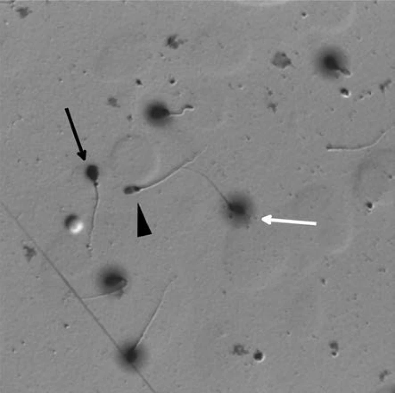 Spermie zpracované testem na disperzi chromatinu – Halosperm. Bílá šipka ukazuje zdravou spermii (H) s rozptýleným chromatinem kolem hlavičky („halo“ efekt), černá šipka ukazuje spermii s fragmentovanou DNA (F), černý trojúhelník spermii degenerovanou (D)
Fig. 2. Sperm processed by chromatin dispersion assay (Halosperm). The white arrow indicates healthy sperm (H) with a dispersed chromatin around the head („halo“ effect), the black arrow indicates the sperm with fragmented DNA (F) and the black triangle shows the degenerated sperm (D)