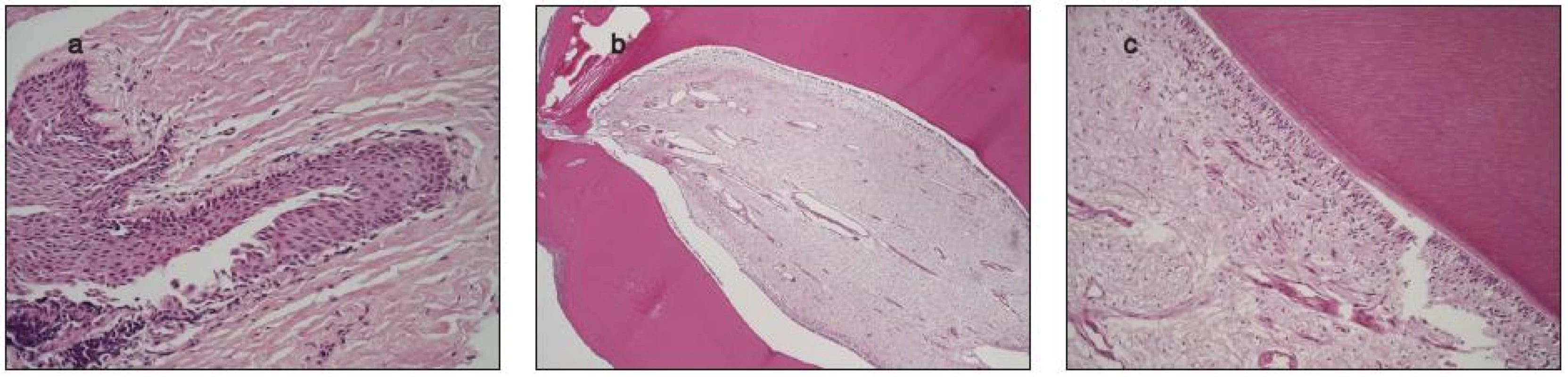 Histologický nález dentálnych štruktúr – 6a, b, c
6a – Cystický útvar s fibróznym puzdrom je vystlaný nerohovatejúcim dlaždicovým epitelom
6b – Súčasťou cystickej dutiny je útvar pripominajúci zub, tvorený dentínom a pulpou z cievnatého fibrózneho tkaniva. Od dentínu oddeľuje pulpu vrstva cylindrického epitelu
6c – Cylindrický epitel oddeľujúci dentín od pulpy má svetlú cytoplazmu s jadrami uloženými v rôznej výške .Farbenie-Hematoxylín a eozín, 25x, 100x