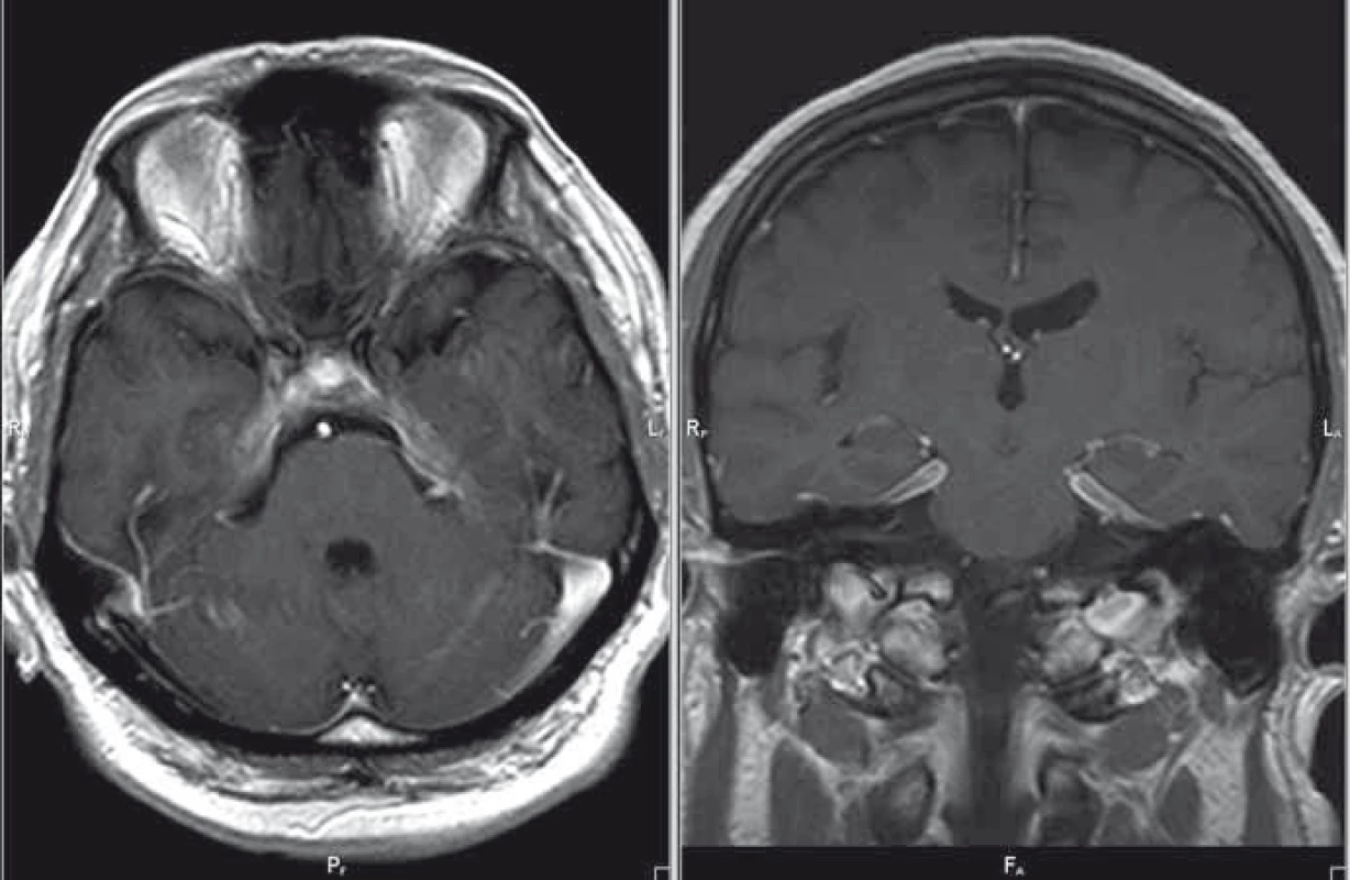MR mozku, postkontrastní T1 vážené obrazy v axiální/koronární rovině; regrese nálezu – kazuistika 1.
Fig. 3. Brain MRI, contrast-enhanced T1-weighted images in the axial/coronal plane; disease regression – a case report 1.