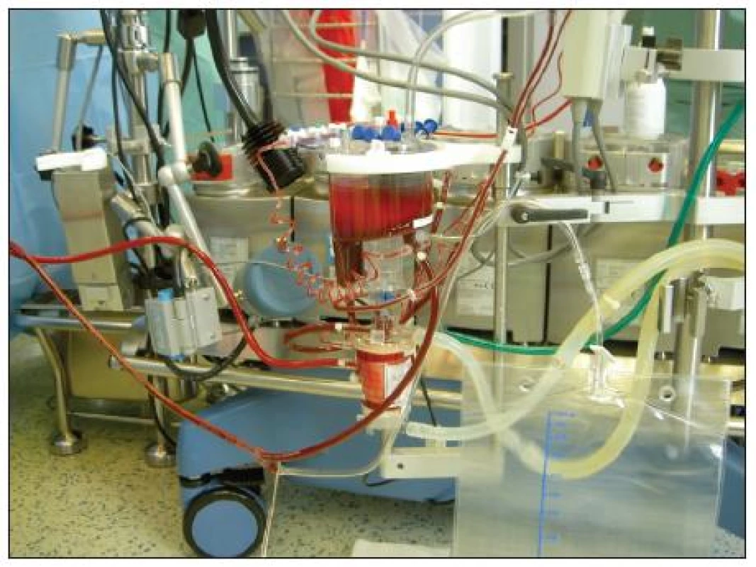 Přístroj pro mimotělní oběh (miniaturní oxygenátor i hadicový set, vak na uskladnění a likvidaci perfuzátu)
Fig. 2. Extracorporeal circulation apparatus (miniature oxygenator and a set o tubes, a sac for storage and disposal of the perfusate)