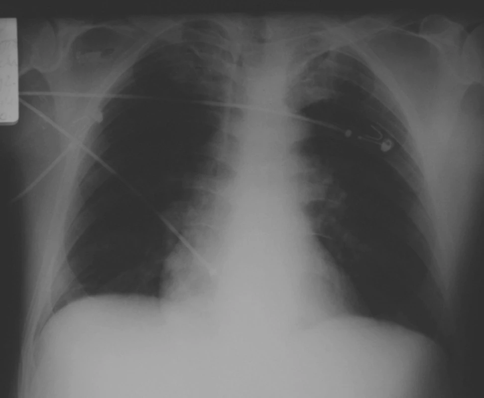 RTG nález pred odpojením od ventilátora
