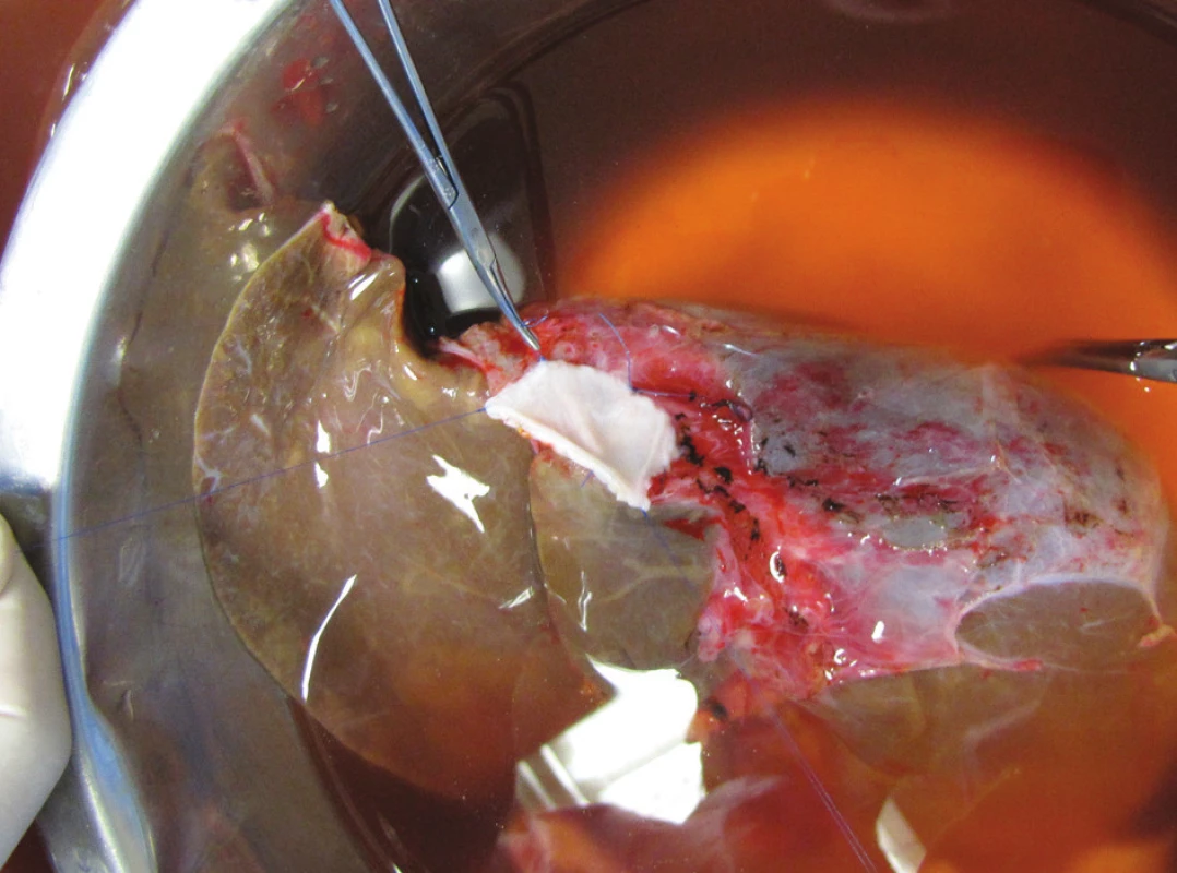 Našitá venoplastika z ilické cévy kadaverózního dárce na dolní dutou žílu štěpu
Fig. 4. Venoplasty, collected from an iliac vessel in a cadaveric donor, attached to v. cava inferior of the graft