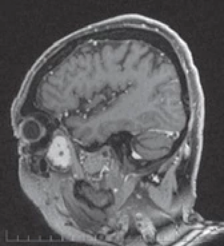 Pre-operative MRI – second case.