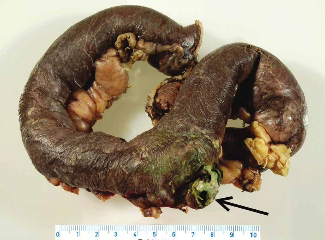 Makroskopický preparát
Fig. 2. Macroscopic preparative
