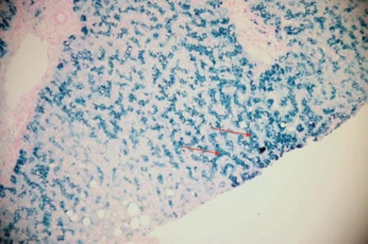 Biopsie jater, abnormální akumulace železa. Zvětšeno 200×, barvení dle Perlse zvýrazňující hemosiderinový pigment jako modrý. Fig. 􀍸. Liver biopsy, abnormal iron accumulation. Magnifi ed 200×, Perls staining highlighting hemosiderin pigment as blue.
